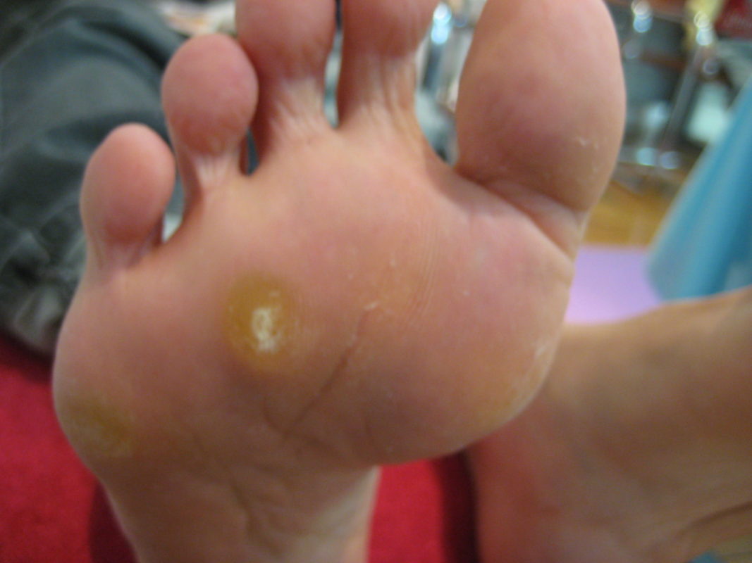 タコ ウオノメ 足指の痛みが悩みで作ったオーダーインソール オーダーインソールのクイスクイス